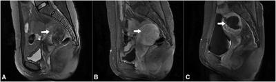 Factors influencing treatment decisions in HIFU treatment of adenomyosis: A retrospective study